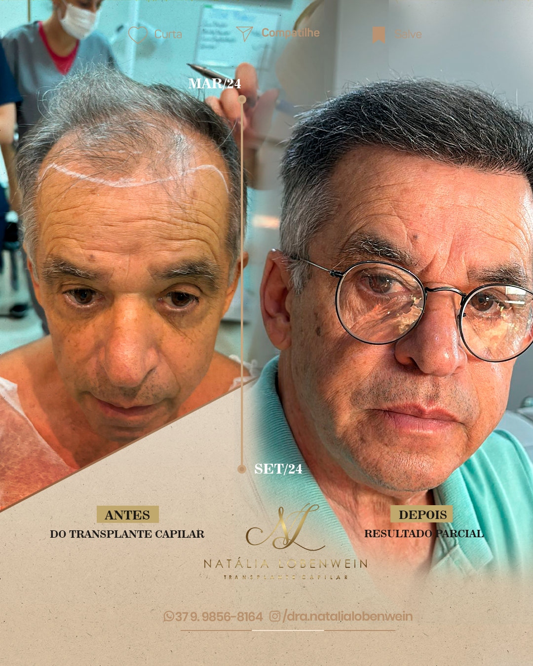 Resultado implante capilar
