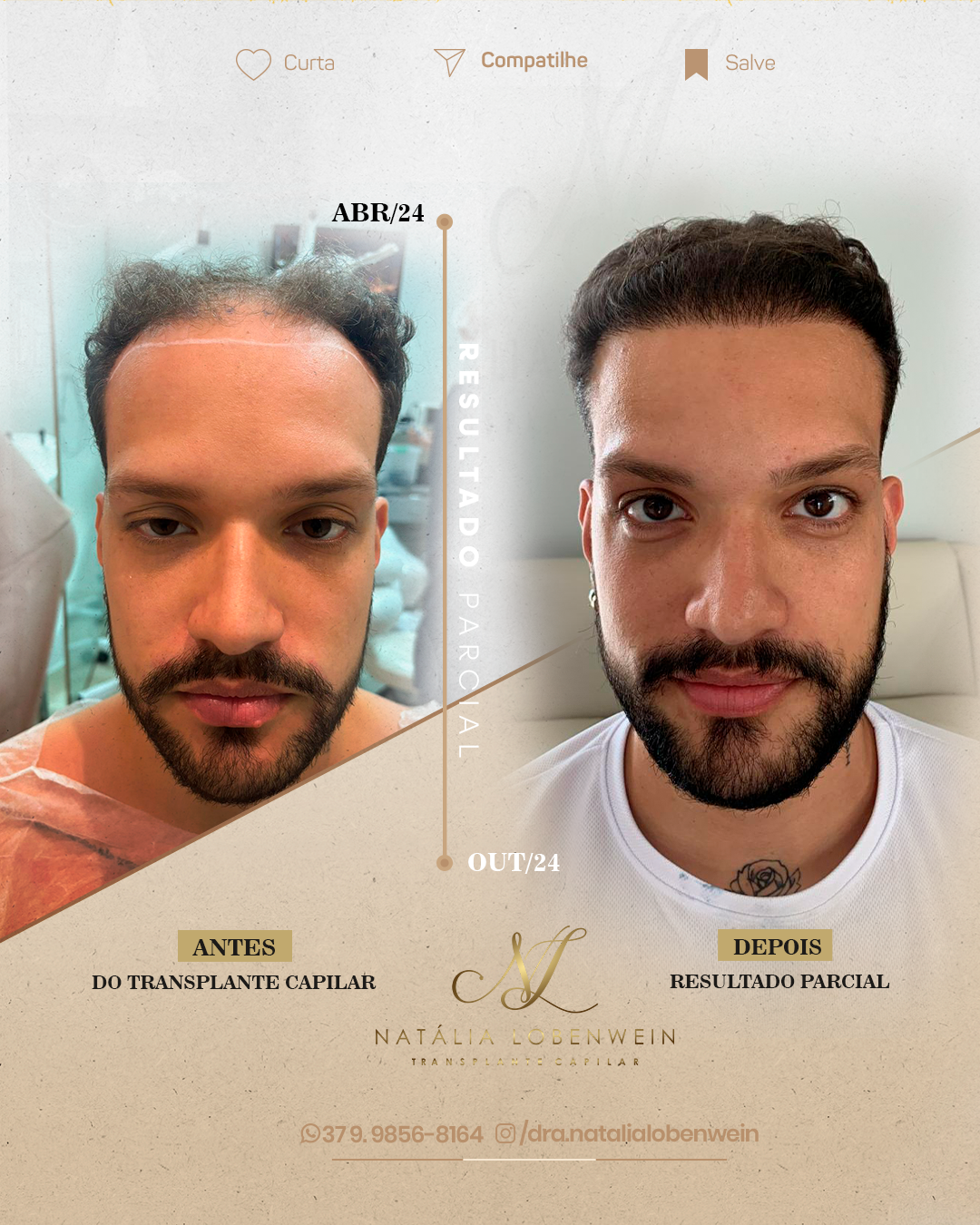 Resultado transplante capilar