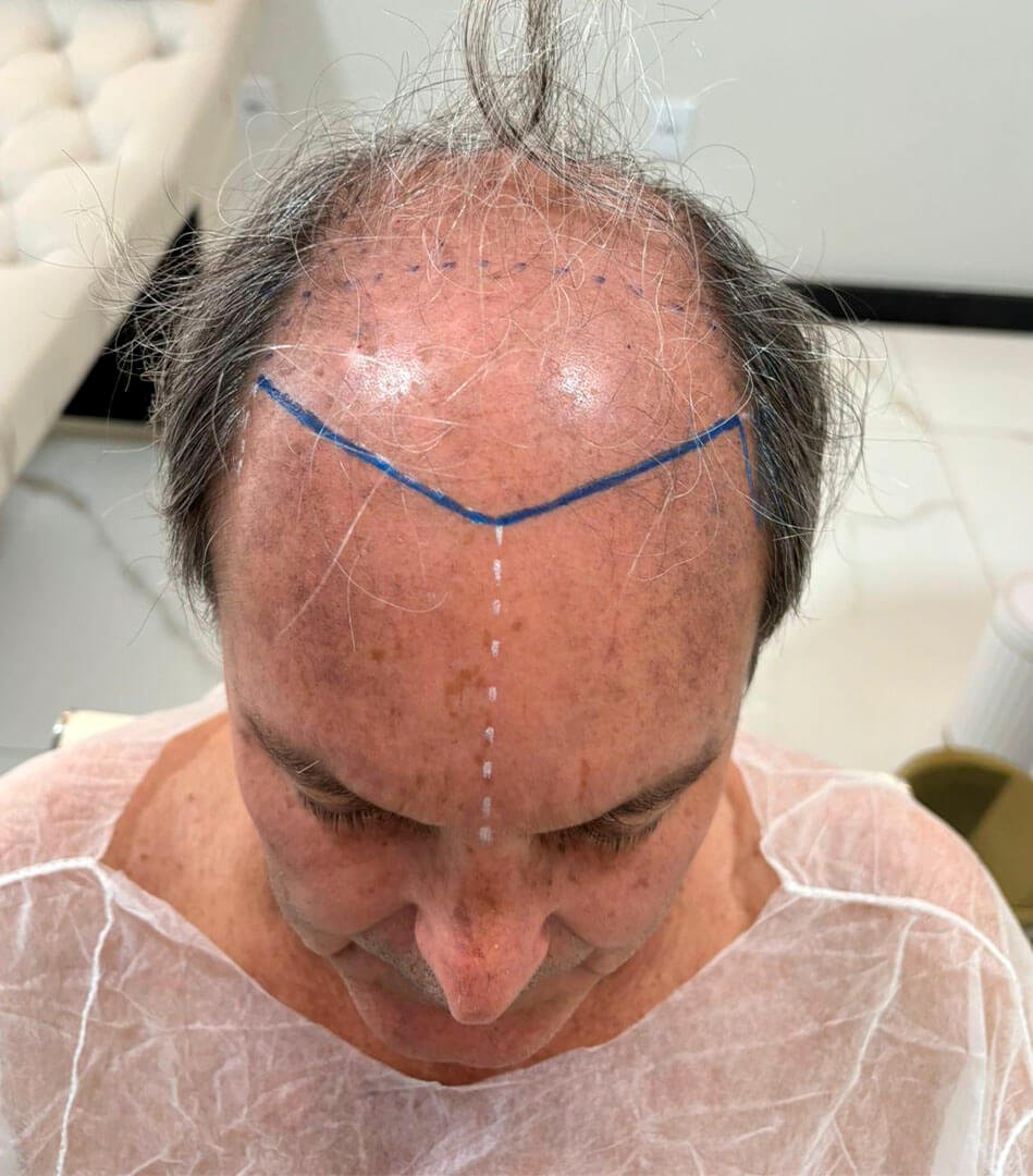 antes do transplante capilar