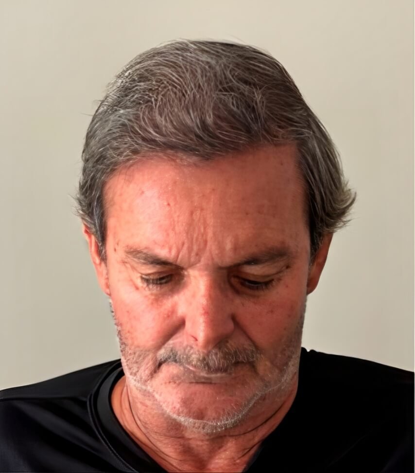imagem site antes e depoisdepois do transplante capilar