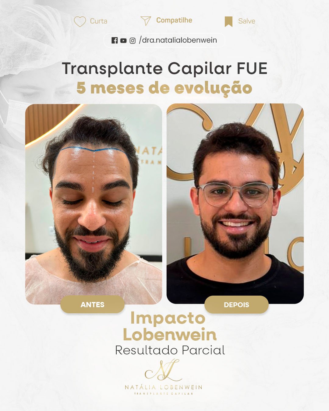 Resutado implante Capilar