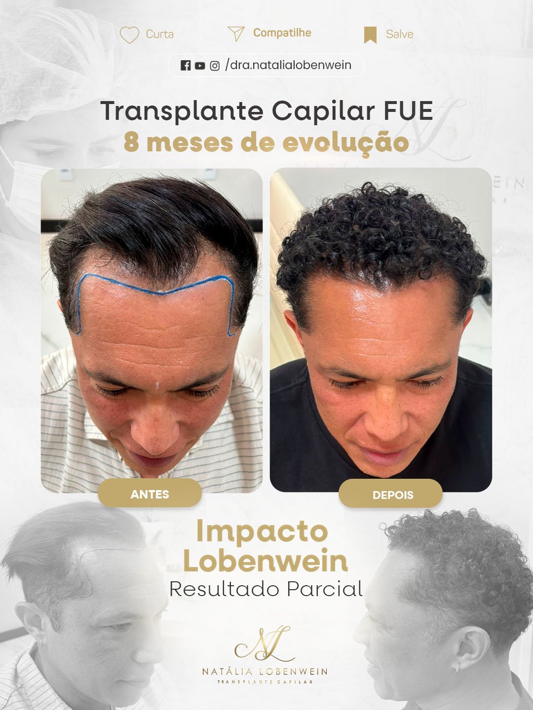 resultado transplante Capilar