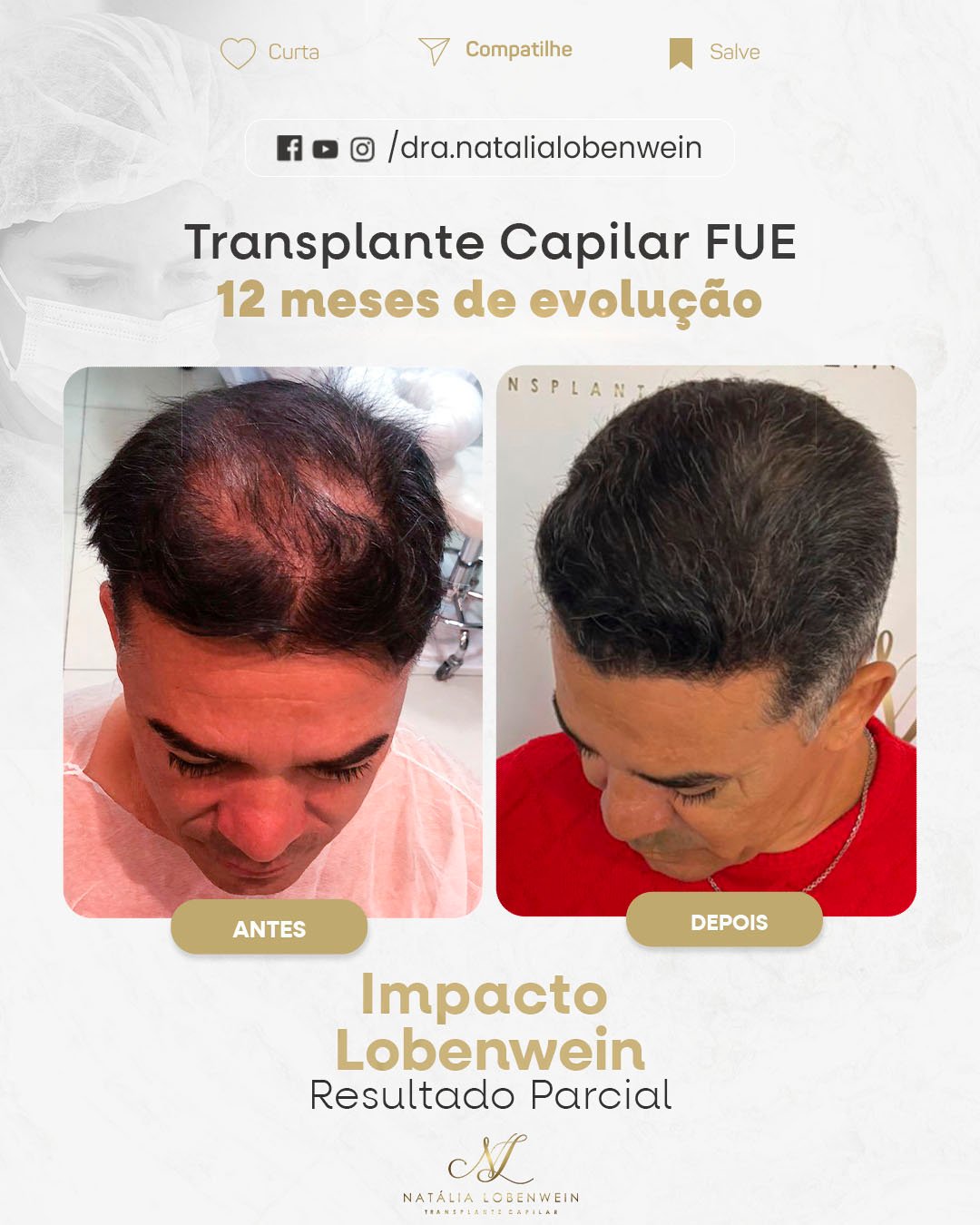 resultado transplante Capilar 01