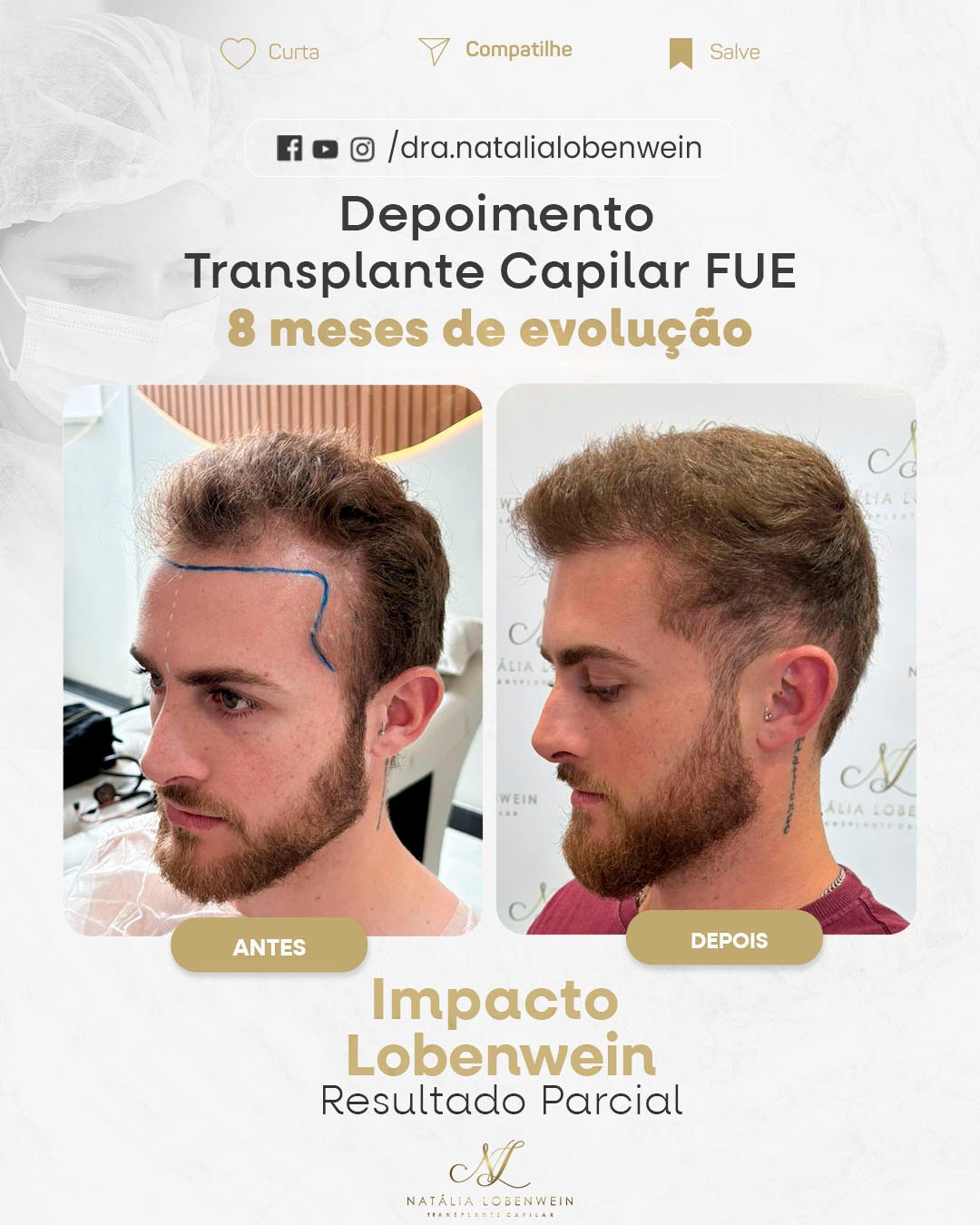 resultado transplante Capilar 02