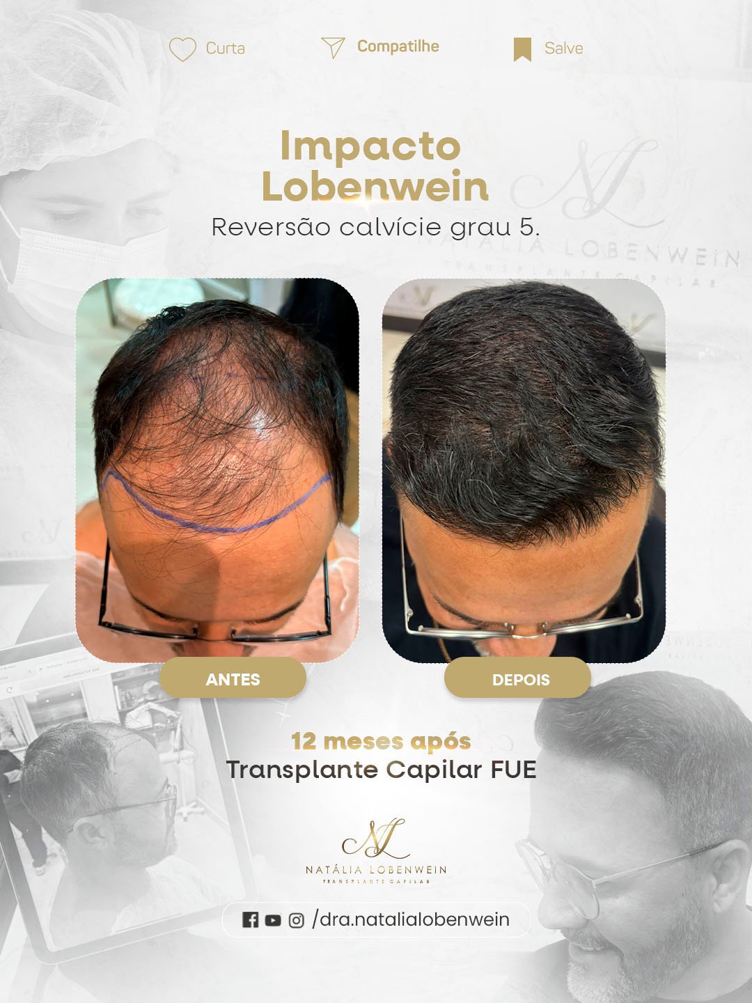 resultado transplante Capilar fue