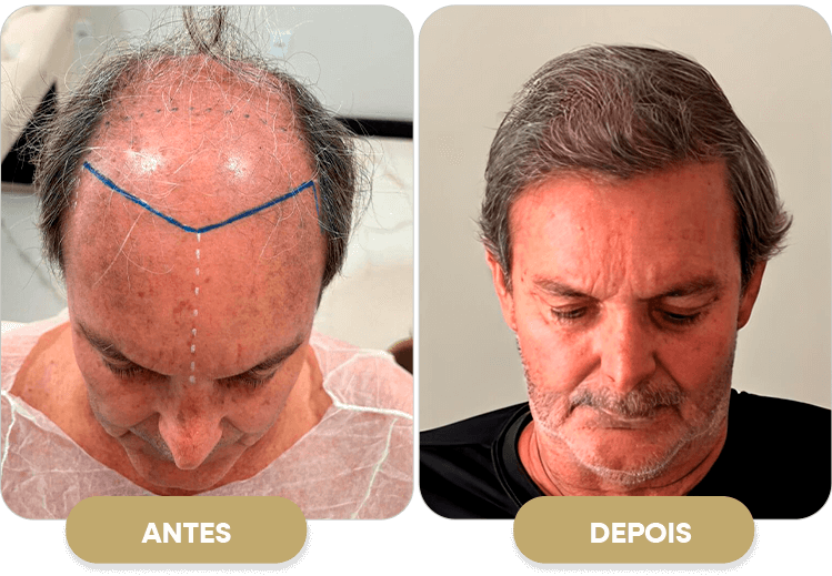 antes-e-depois-implante-capilar (1)