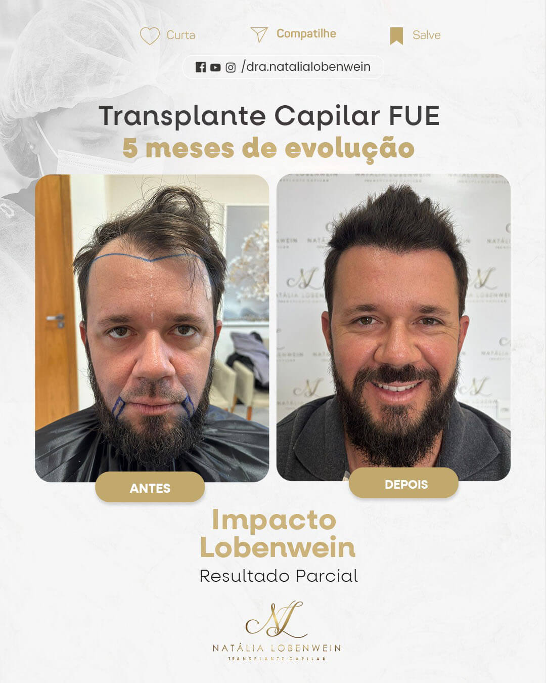 resultado implante capilar fui