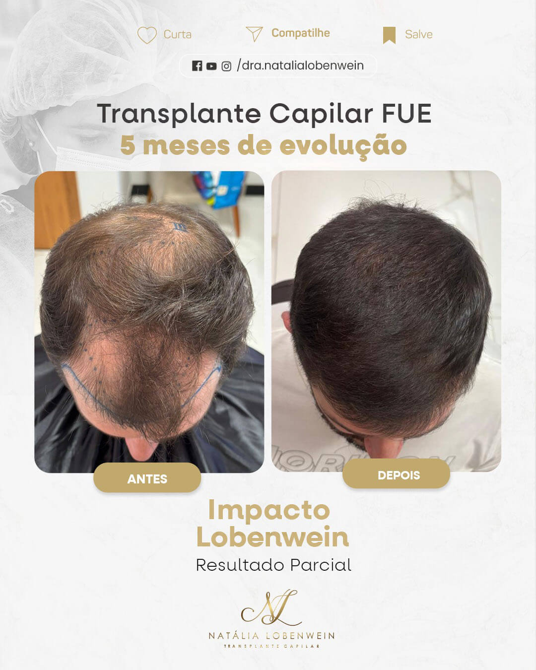 resultado pos implante capilar