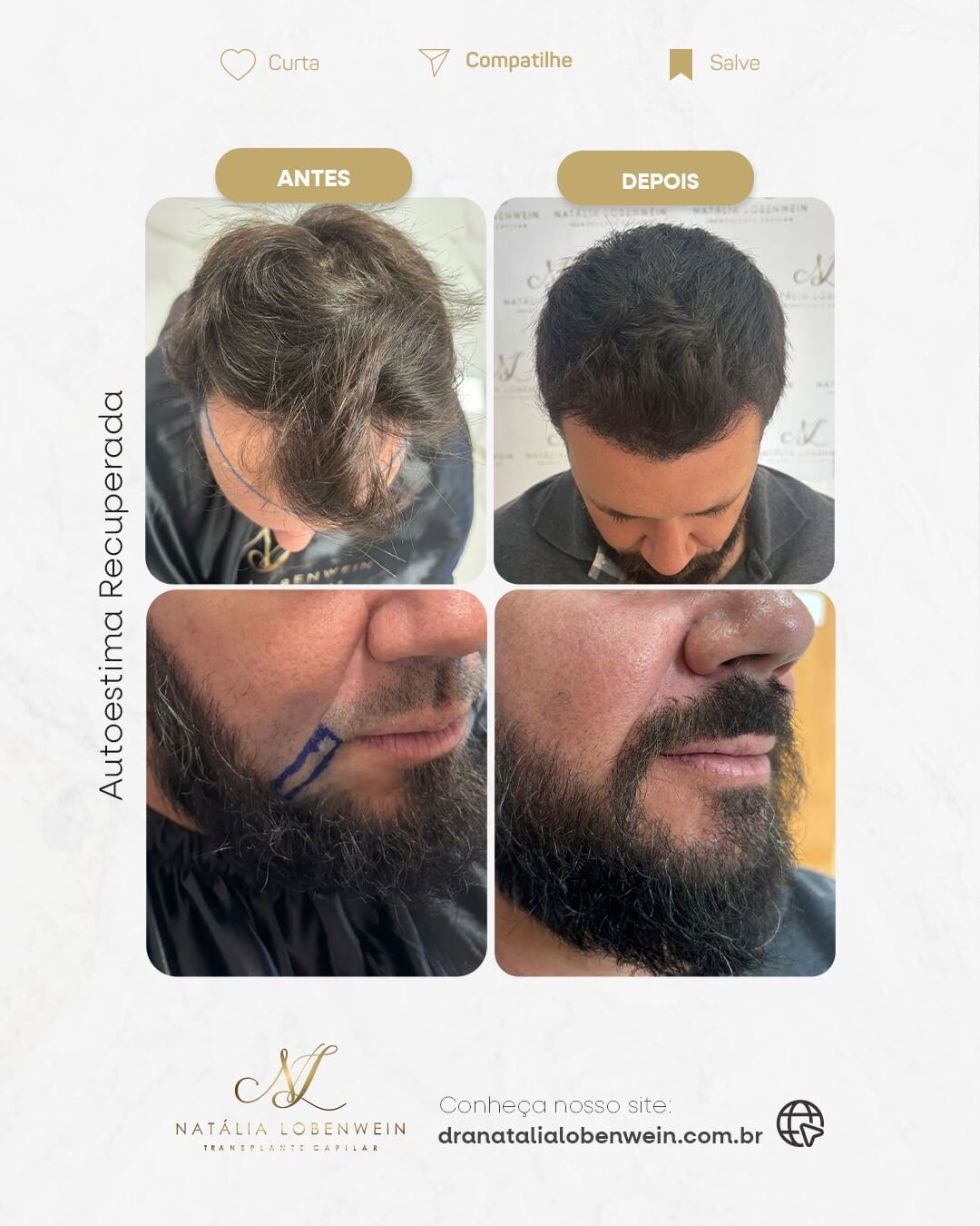 resultado transplante capilar fue