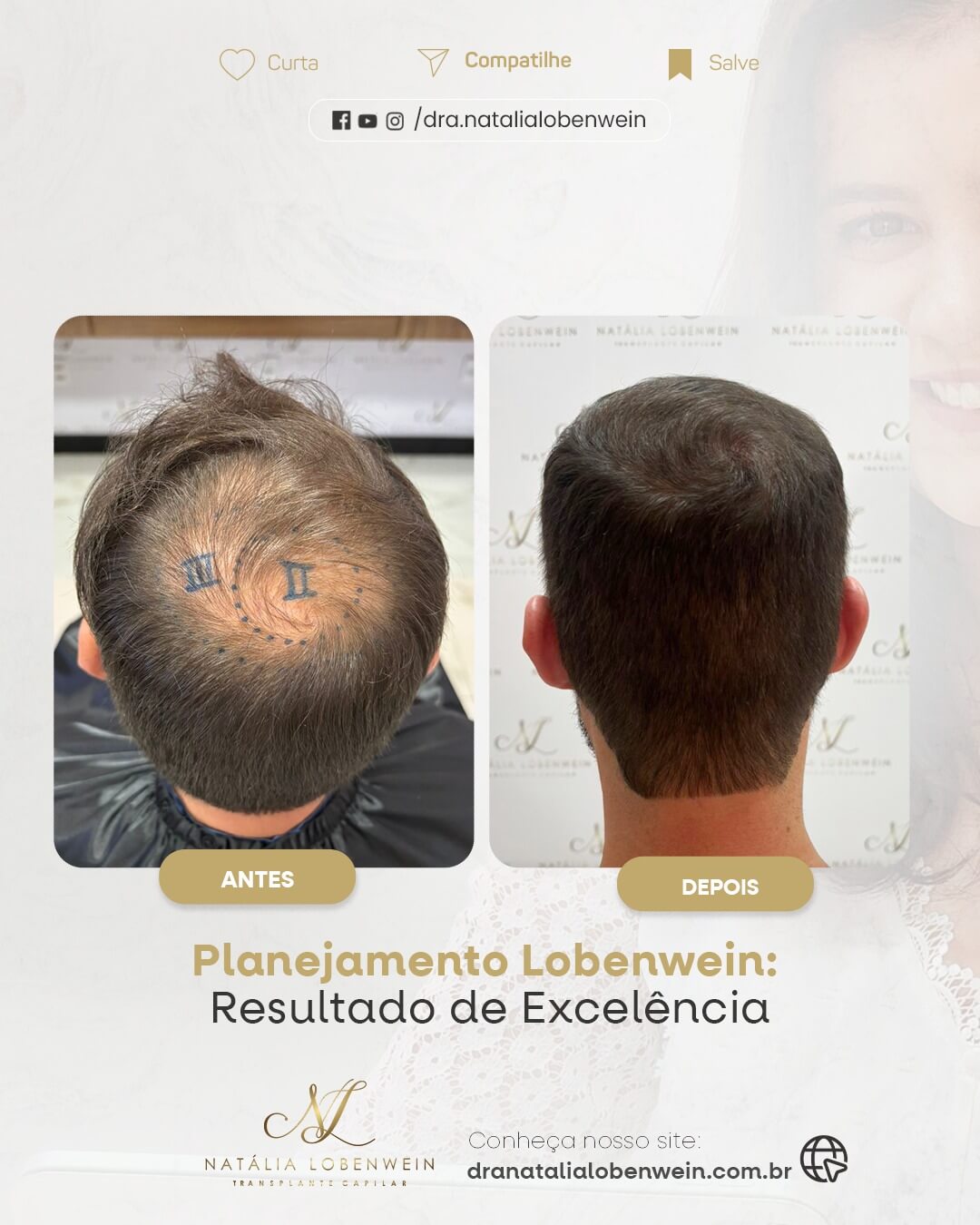 resultado transplante capilar