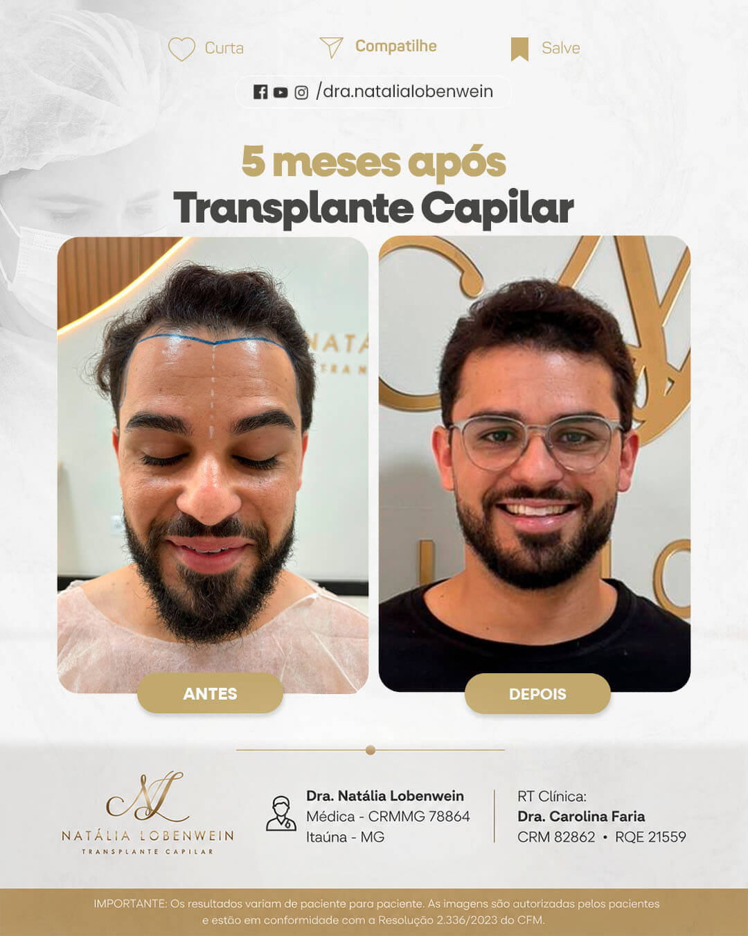 resultado-transplante-capilar01 copiar 2
