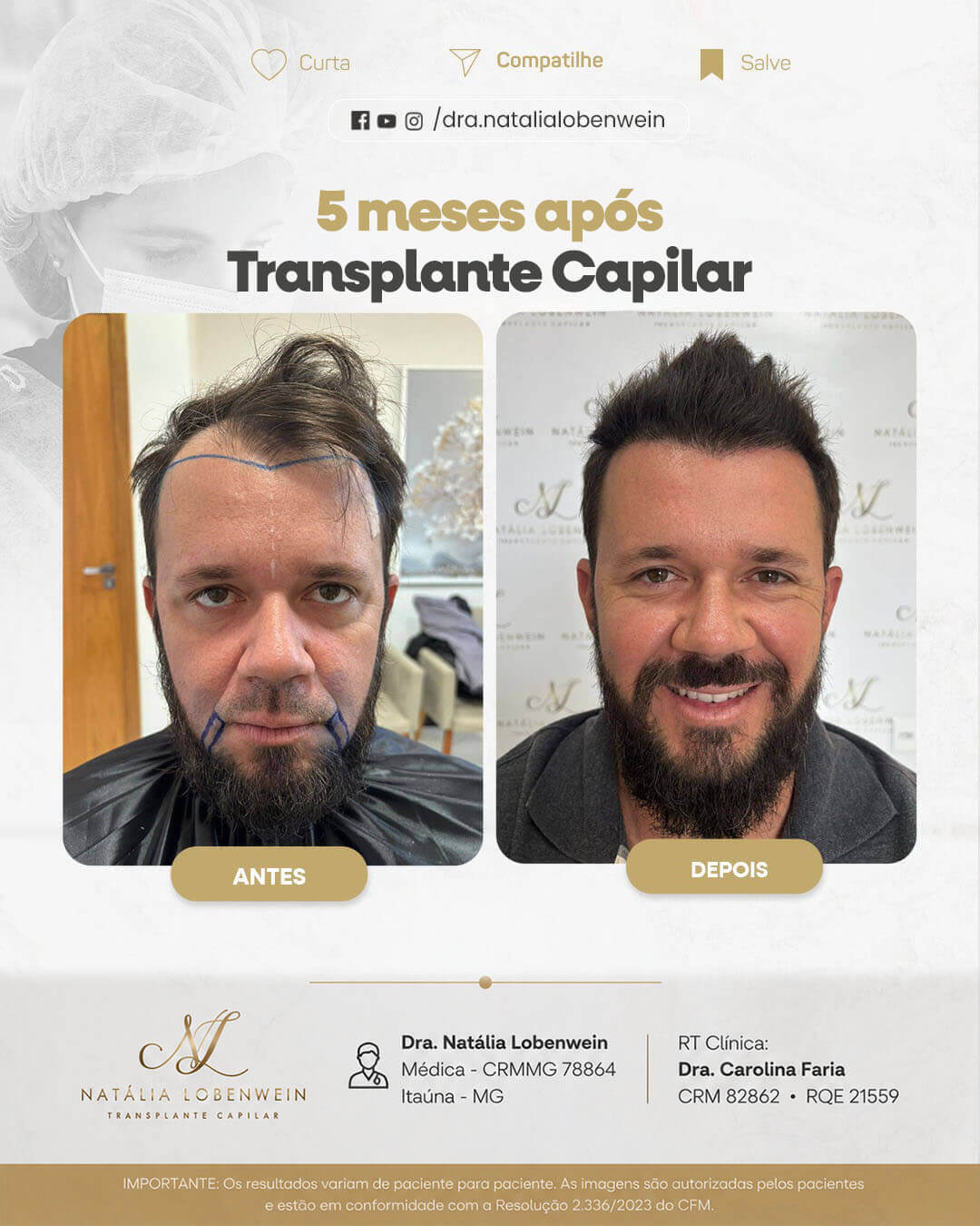 resultado-transplante-capilar01 copiar 3
