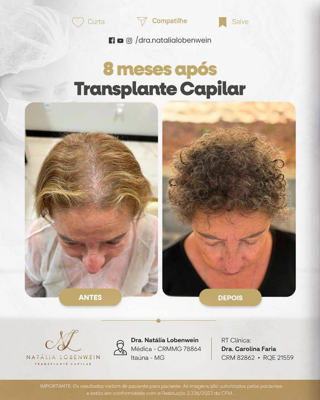 resultado-transplante-capilar01 copiar 5