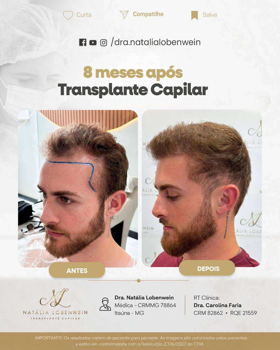 resultado-transplante-capilar01 copiar 5