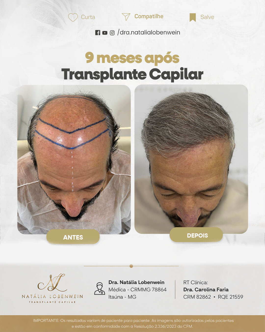resultado-transplante-capilar01 copiar 6