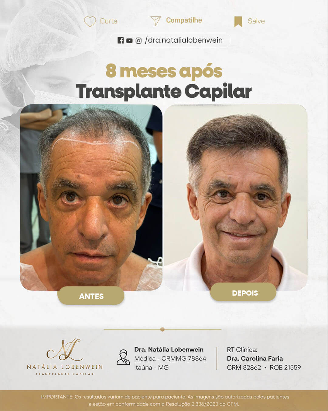 resultado-transplante-capilar01 copiar 7