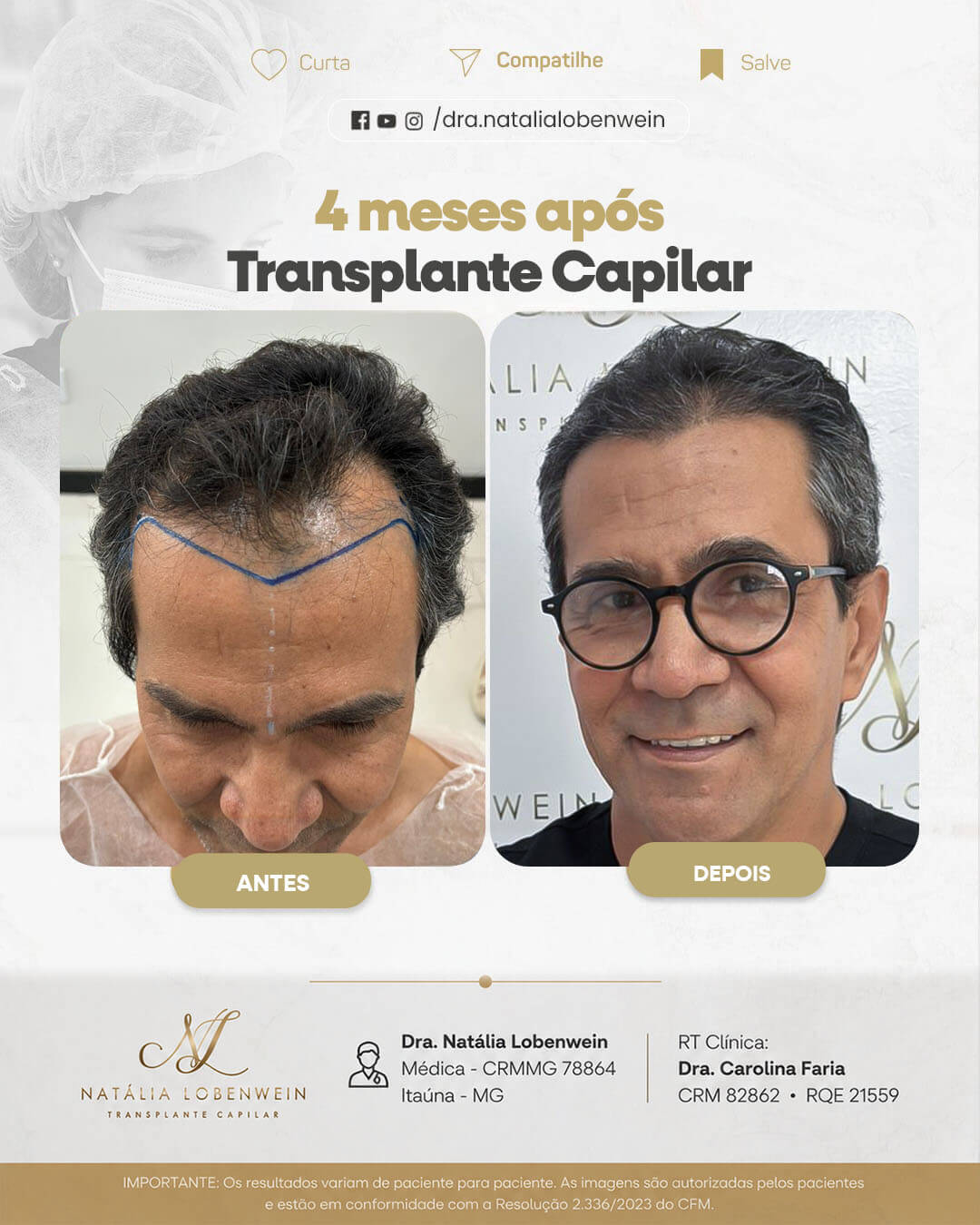 resultado-transplante-capilar01 copiar 8
