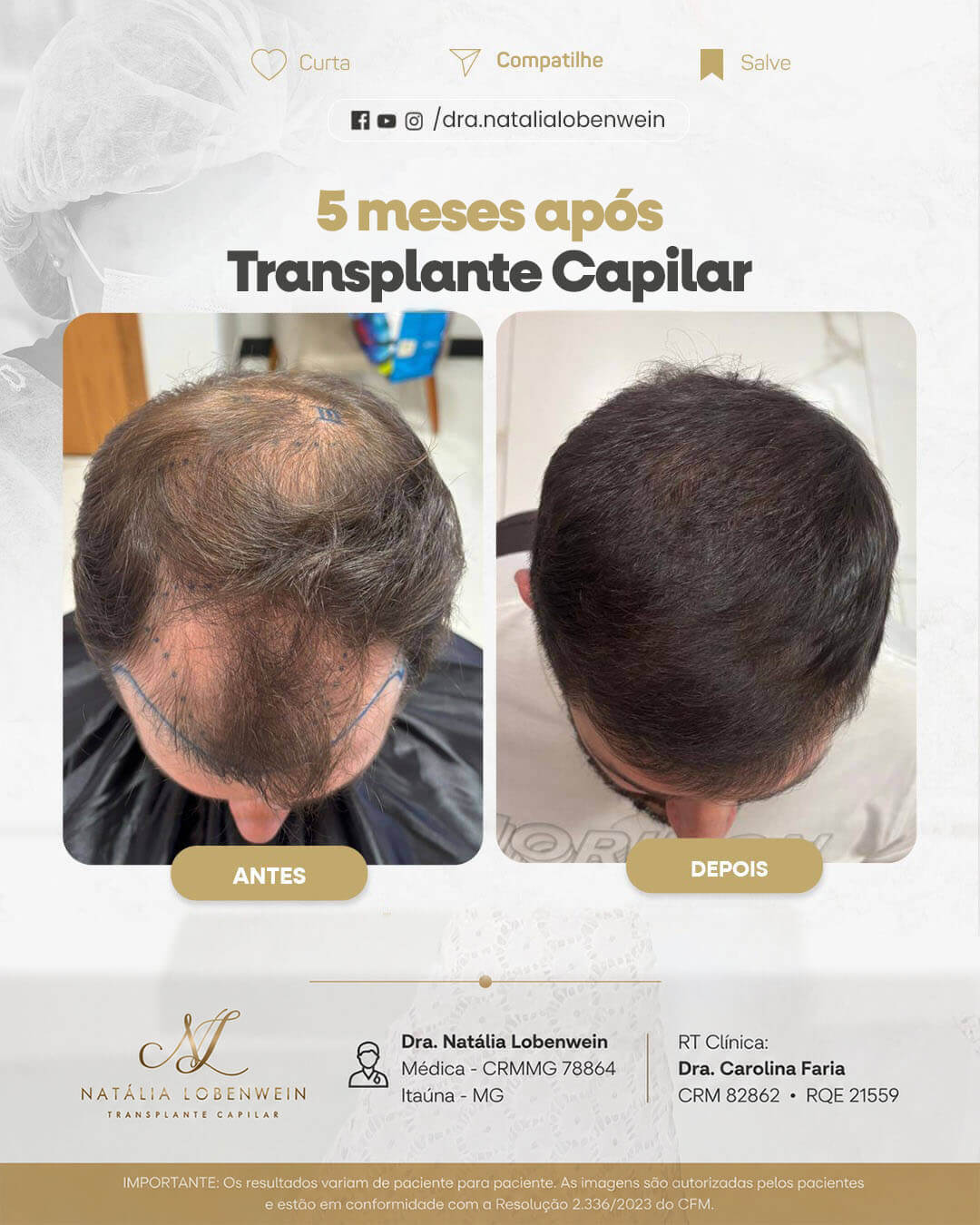 resultado-transplante-capilar01 copiar