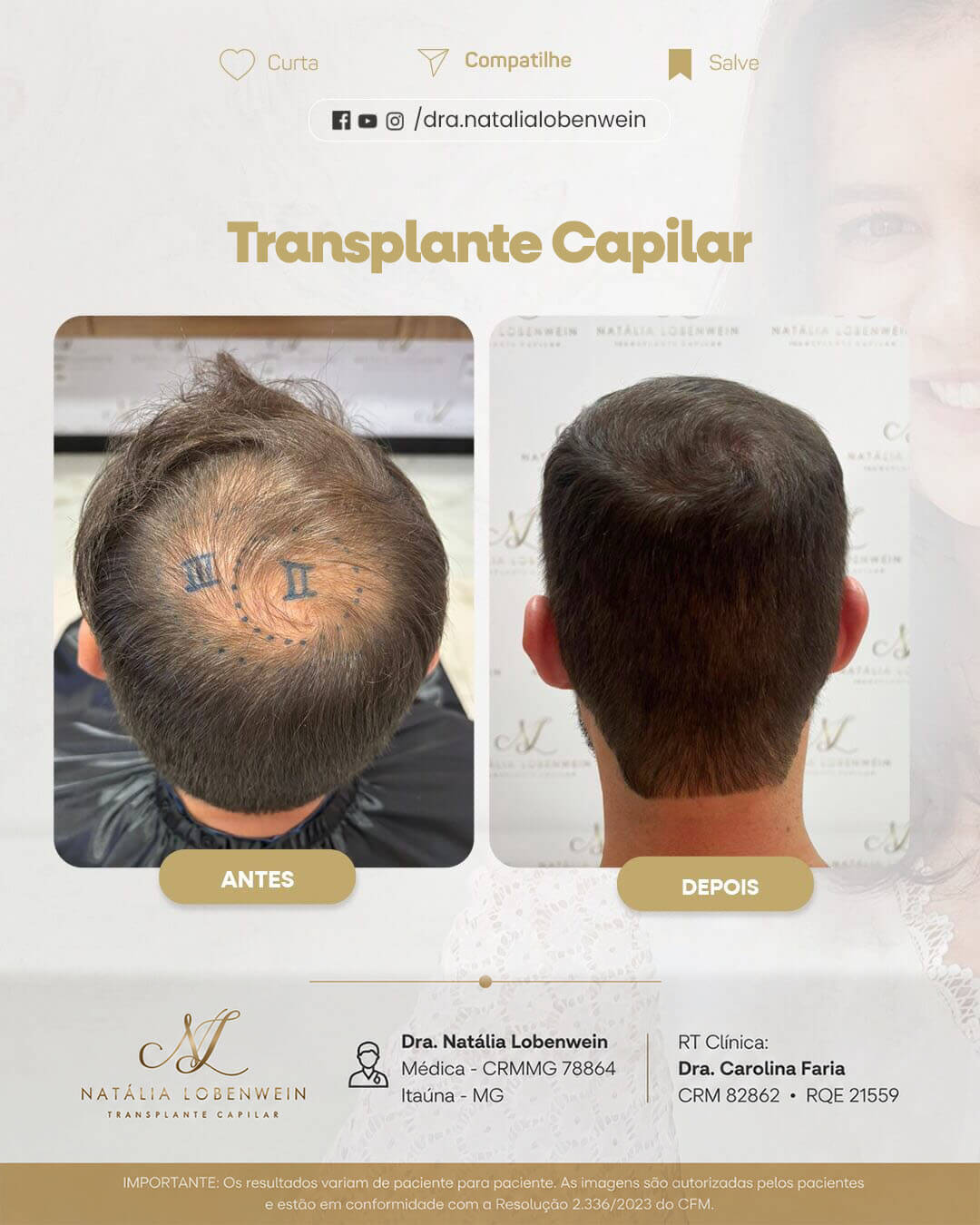 resultado-transplante-capilar01