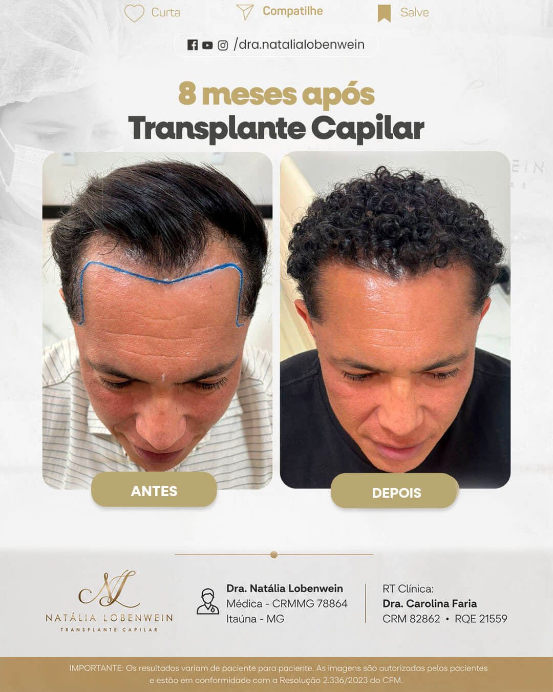 resultado-transplante-capilar0101 copiar 3