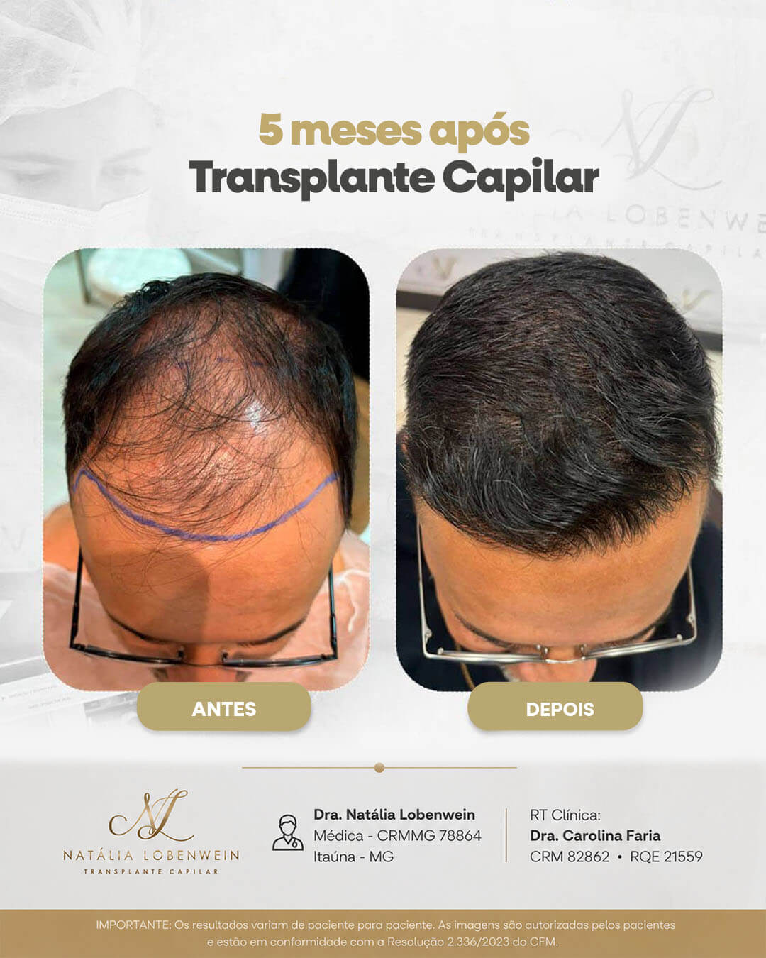 resultado-transplante-capilar0101 copiar 4