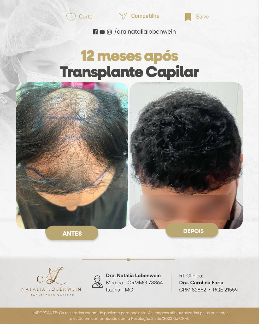 resultado-transplante-capilar0101 copiar 7