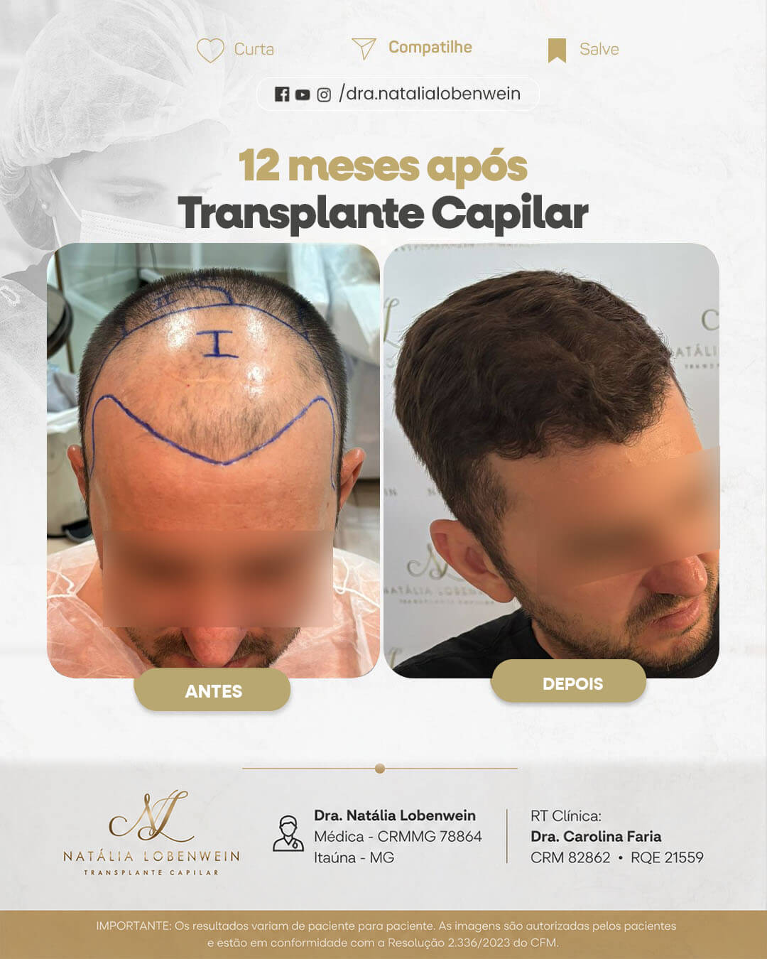 resultado-transplante-capilar0101 copiar 9 (1)